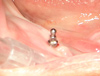 Вид установленных миниимплантатов на нижней челюсти