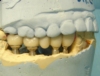 Металлокерамический протез зубов на модели