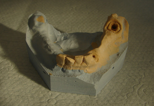 Модель нижней челюсти. Результат увеличения костной ткани по ширине