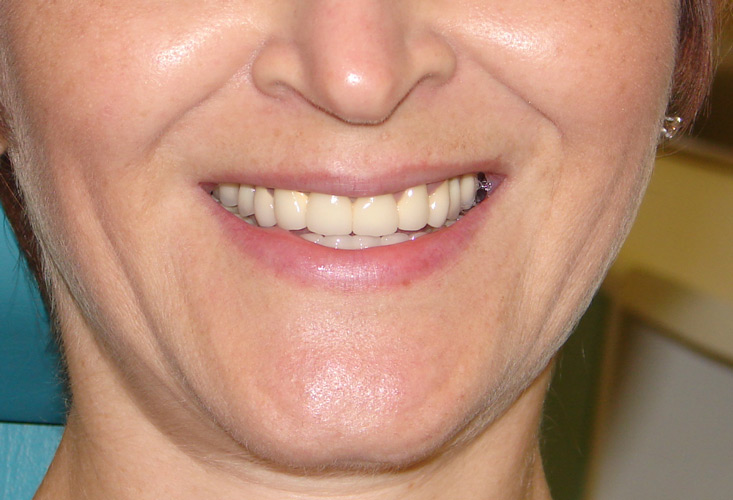 Фотография естественной улыбки после имплантации и протезирования на имплантах. Имплантация зубов