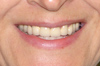 Естественная линия улыбки с протезом на имплантатах