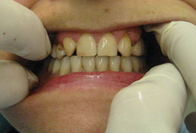 Временный съемный протез после удаления зубов