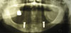 Контрольная рентгенограмма с установленными имплантатами Конмет