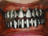 Металлическая литая конструкция зубного протеза