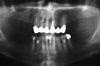 Ортопантомография с разметкой планируемых к установке зубных имплантатов