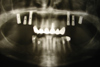 Контрольная рентгенограмма с установленными имплантатами и измененной высотой правой гайморовой пазухи