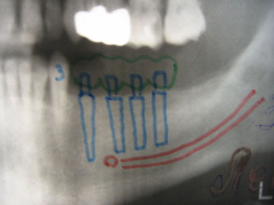 Схема  планирования операции  установки  4 имплантатов  при концевом  дефекте зубного  ряда.  Проекция нижне-луночкового нерва обозначена красным цветом