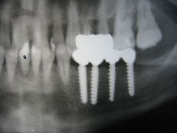 Контрольная рентгенограмма через 3 года после имплантации. Протезирование з авершено  через 1 месяц после имплантации.
