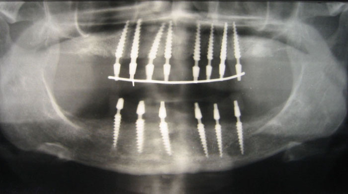 Контрольная   рентгенограмма   после  установки  14 Конических винтовых имплантатов. В день операции Установлены провизорные акриловые протезы.