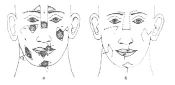 Схема местной пластики изъянов кожи лица различной формы и локализации