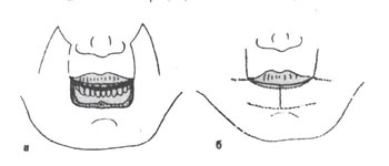 Восстановление нижней губы при тотальном изъяне сквозными лоскутами, выкроенными из верхних отделов носогубных складок
