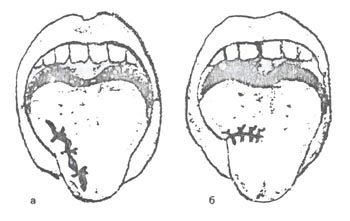 Схема наложения швов на рану языка