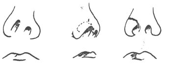 Схема пластики крыла носа при помощи разреза типа «Кочерга»