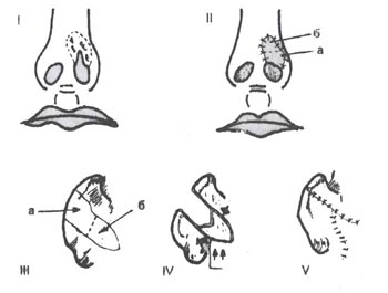 Схема ринопластики свободной пересадкой сложного трансплантата из ушной раковины с дополнительным кожным лоскутом