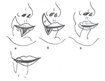 Устранение срединного изъяна нижней губы по методу Эстландера.