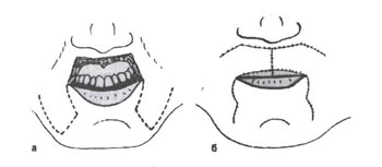 Восстановление верхней губы при тотальном изъяне сквозными лоскутами, выкроенными из нижних отделов носогубных складок